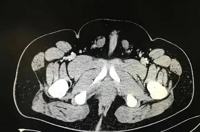 남성과 여성 생식기를 모두 갖고 있는 리우의 X레이 사진.사진 출처=웨이보, 사우스차이나모닝포스트