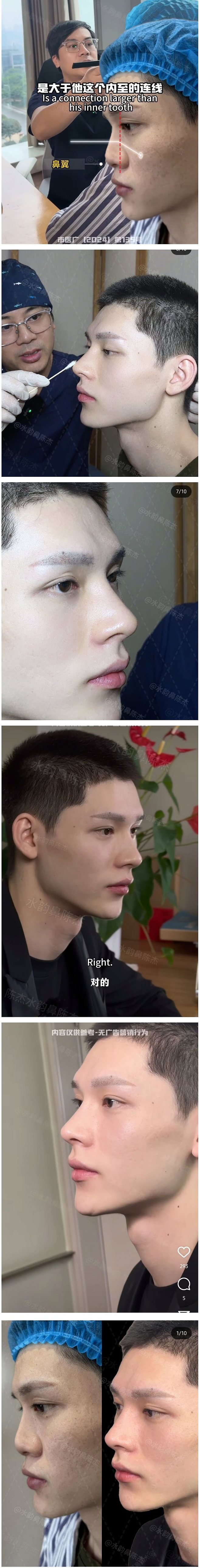 image.png 역대급 남자 코수술 전&후 차이