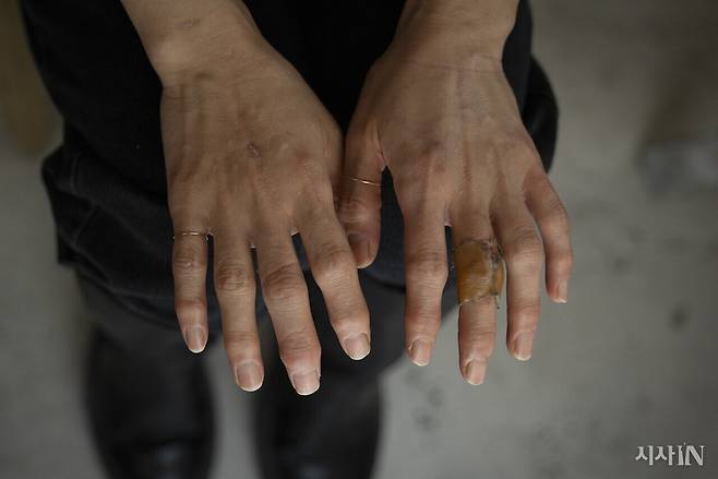 9년 동안 무거운 생맥주 통을 옮기고 쉴 새 없이 요리를 해온 나혜림씨의 손가락 관절이 불거졌다. ⓒ시사IN 이명익