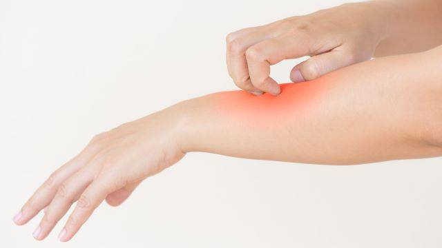 모기에 물린 부위가 과도하게 부풀어 오르는 등 알레르기 반응이 심하게 나타난다면 스키터 증후군을 의심해 볼 수 있다 | 출처: 클립아트코리아