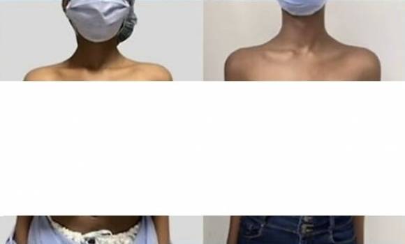 백신 접종 후 트리플G컵으로 커진 모습(좌), 축소술 받은 후 D컵으로 작아진 모습(우). 사진=Plastic & Reconstructive Surgery-Global Open 캡처