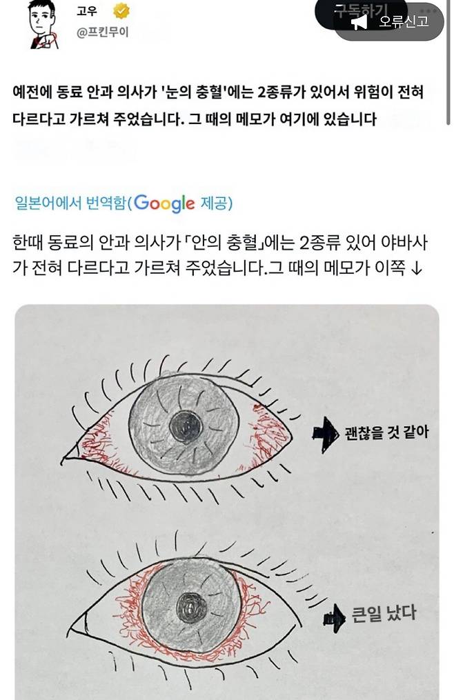 RsuFFE.jpg 눈 충혈 종류에 따른 위험도