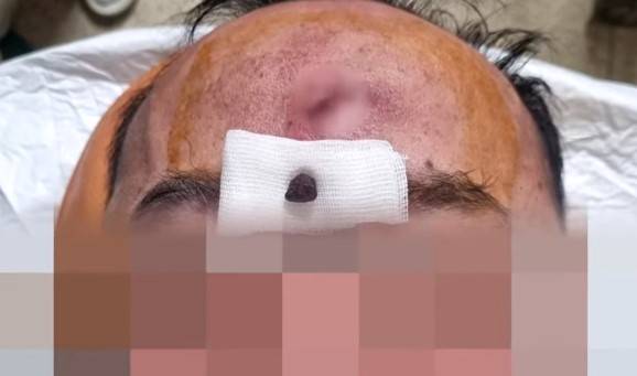 A씨의 이마에서 나온 돌멩이 [사진=JTBC '사건반장' 캡쳐]