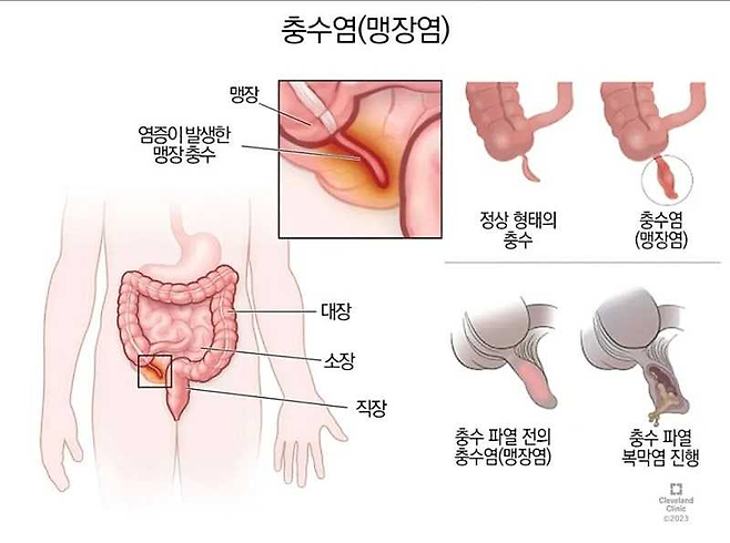 image.png 인류의 수명을 거의 두배로 늘려준 수술.jpg
