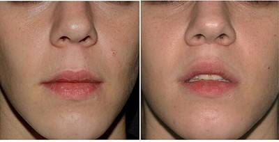 입술 거상술. [사진=영문 위키 백과]