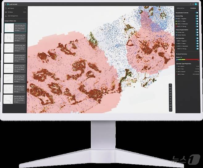 루닛 스코프 HER2 활용 모습.(루닛 제공)/뉴스1
