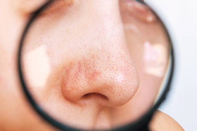 블랙헤드는 과도하게 분비된 피지가 모공에 쌓여 각종 노폐물과 결합하면서 산화돼 검게 변한 것이다./사진=게티이미지뱅크