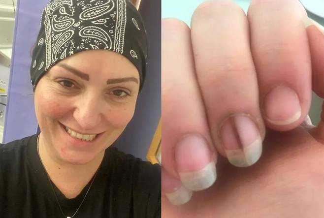 영국 여성 켈리 헤더(38)가 손톱에 검은 선이 생긴 후 흑색종 진단을 받았던 사연이 공개됐다./사진=더 선 캡처