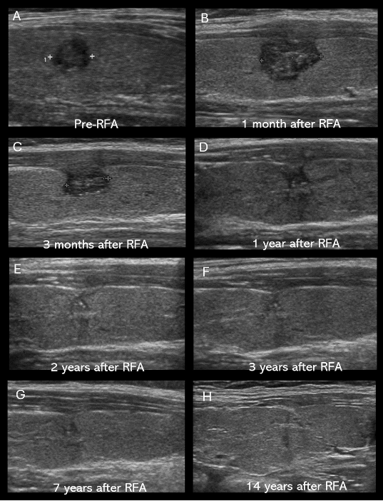 Ultrasound images from the study published in "Thyroid" illustrate the gradual decrease and disappearance of microcalcifications in papillary thyroid microcarcinoma following radiofrequency ablation. (Haeundae Sharing and Happiness Hospital)