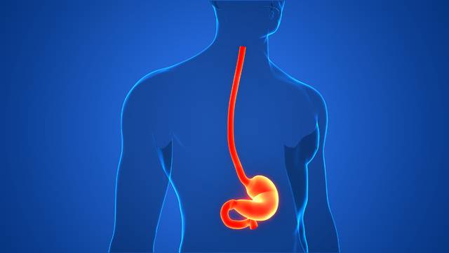 역류성식도염으로 항역류 수술을 받게 되는 환자의 예후를 예측하는 기술이 개발됐다. 사진은 기사의 특정 사실과 관련 없음. 게티이미지뱅크