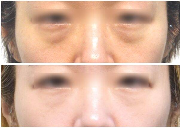 젊은 층에서도 눈밑지방은 피로와 노화의 느낌을 준다.