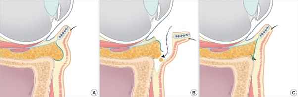 눈밑지방재배치 시에 단순히 지방을 끌어내리는 것에서 그치지 않고 약화된 안와격막을 강화시켜 주는 '격막강화술'을 함께 시행하기도 한다. [사진=Arch Aesthetic Plast Surg > Volume 20(3); 2014]