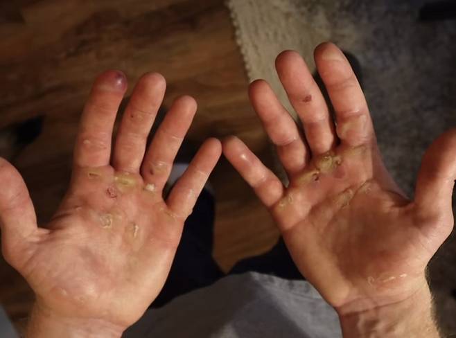 미국 20대 남성이 하루에 턱걸이 1만 개를 하는 챌린지 후 손이 물집과 상처로 뒤덮인 사연이 공개됐다./사진=트루엣 헤인스 인스타그램(@just_truett) 캡처