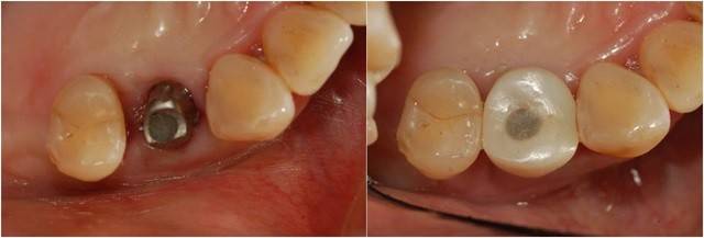 임플란트 수술 전후 이미지 | 출처: 연세굿플란트치과의원