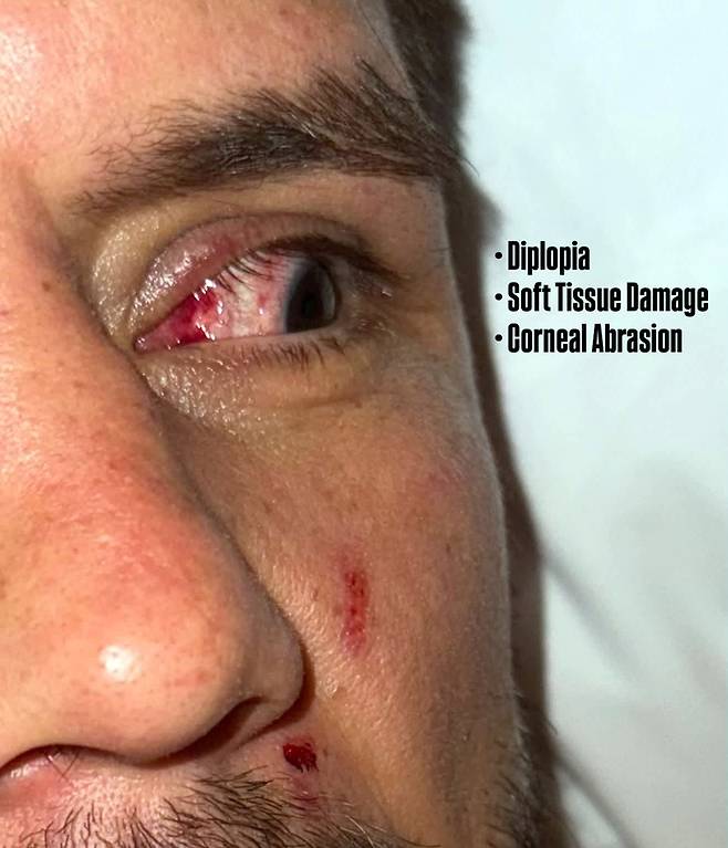 세후도가 최근 자신의 SNS에 게시한 눈 사진.  실명될 수 있는 것으로 알려졌다. 사진출처 | 세후도 SNS