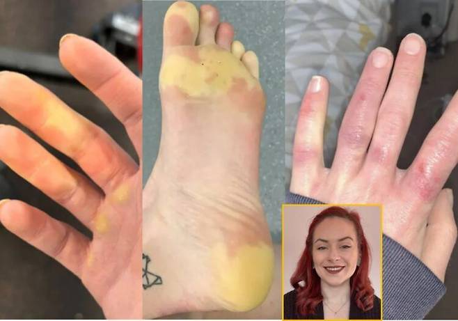 혈액순환 문제로 발이 노랗게 변하고 타는 듯한 통증을 겪는 한 여성의 사연이 전해졌다. 사진=영국 일간 더선 캡처