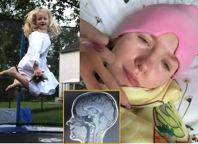 뇌의 하부가 두개골 밖으로 밀려나 척추관을 압박하는 장애를 앓고 있는 에밀리의 모습. [사진=영국 일간 더선 보도 갈무리]