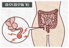 충수(충수돌기)의 위치.