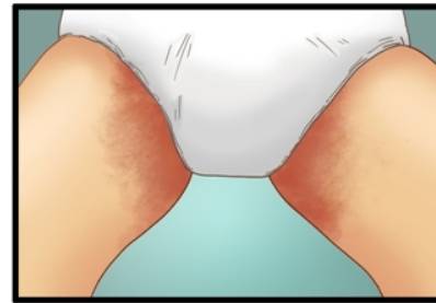 사타구니가 갈색으로 침착됐다면 무좀을 의심해볼 수 있다. /그림=서울아산병원