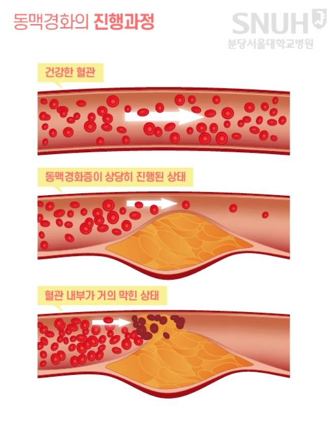 죽종이 동맥 벽에 쌓여 동맥경화가 진행되는 단계. /자료=분당서울대병원