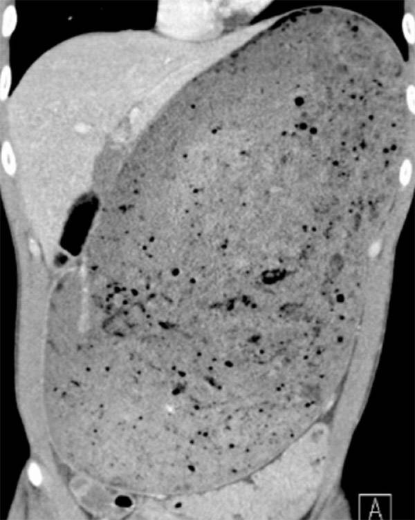 싱가포르의 한 남성이 음식 먹기 대회에서 햄버거를 30분 만에 3㎏을 먹어치운 뒤 응급실에 실려갔다. [위장병학 저널 ‘Gastroenterology’ 갈무리]