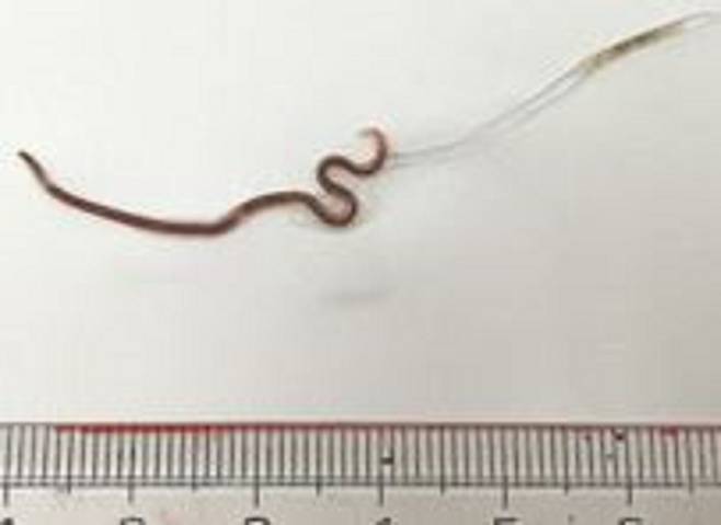 일본의 한 20대 여성이 회를 먹고 난 후 편도선에서 기생충이 발견된 사례가 보고됐다./사진=미국 열대 의학 및 위생 저널