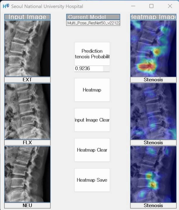 개발한 인공지능 모델을 활용한 요추협착증 진단 예시: 중립, 굴곡, 신전 자세에서 촬영된 X선 사진을 바탕으로 인공지능 모델이 요추협착증을 예측하고, 히트맵으로 예측 근거를 시각적으로 제공한다. 병변 부위는 빨갛게 표시했다. /그림=서울대병원