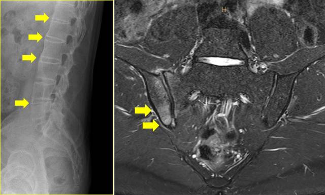 강직척추염 환자의 척추 엑스레이 영상(왼쪽)에서 대나무 척추 변형(화살표)으로 진행된 상태가 관찰된다. 단순 엑스레이 검사로 이상 소견이 발견되지 않아 추가로 자가공명영상(MRI) 검사를 시행한 결과 천장관절의 염증(화살표)이 확인됐다. 사진 제공=순천향대서울병원
