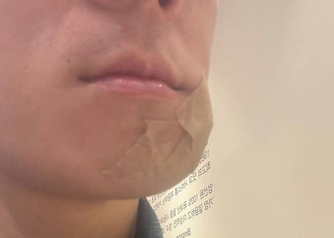 골프공에 맞아 다친 얼굴. 사진 독자 제공, 연합뉴스