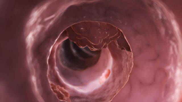 대장암은 용종 크기에 따라 증상 정도가 달라진다 ｜출처: 클립아트코리아