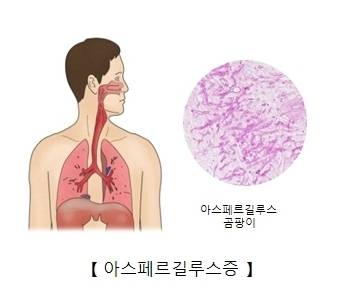 아스페르길루스증 자료 이미지. 서울아산병원 홈페이지 캡처