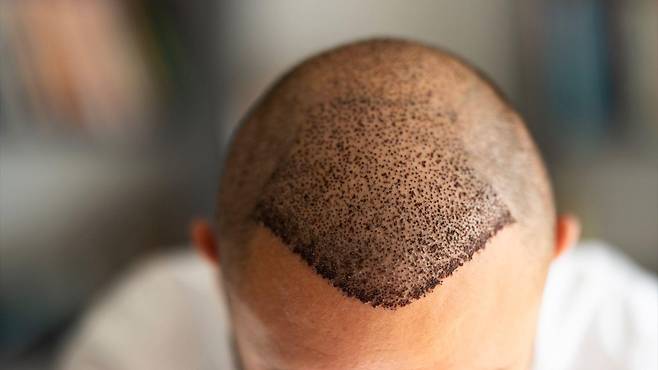 튀르키예 의료관광협회에 따르면 약 100만 명의 관광객들이 지난해 모발이식을 받기 위해 나라를 방문했다