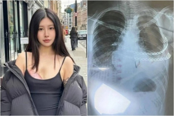 ‘폴란드 증후군’으로 인해 보석으로 만든 보형물을 착용한 쉬안씨. 쉬안 SNS 캡처