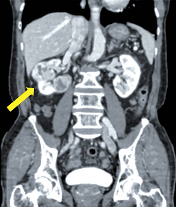 CT로 확인한 신장암 영상 ⓒ서울대병원