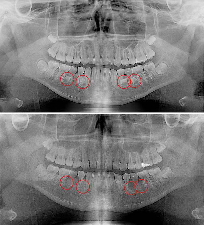[서울=뉴시스] 17일 의료계에 따르면 과잉치를 방치하면 치아의 정상적인 맹출(치아가 잇몸 속에서부터 잇몸을 뚫고 올라오는) 과정에 문제가 생길 수 있고, 추가적인 수술과 교정 치료가 필요할 수도 있다. (사진=고대안산병원 제공) 2025.04.17. photo@newsis.com *재판매 및 DB 금지