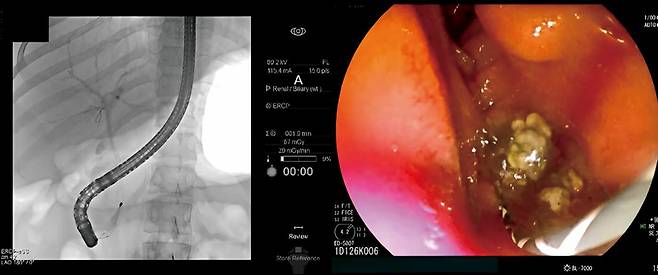 ERCP 시술을 통해 담관 담석을 제거하는 모습 ⓒ한림대동탄성심병원
