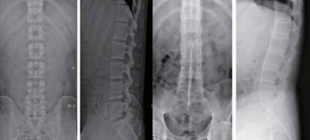 왼쪽 두 사진이 강직성 척추염 환자, 오른쪽 두 사진이 정상 (사진=분당제생병원)