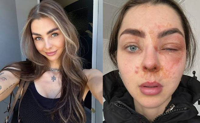 셀러리 주스를 만들던 중 믹서기 속 내용물이 분출되며 얼굴에 1도 화상과 심각한 눈 부상을 입은 한 인플루언서의 사연이 소개됐다. [사진='Kimmy Dutchy'' SNS]