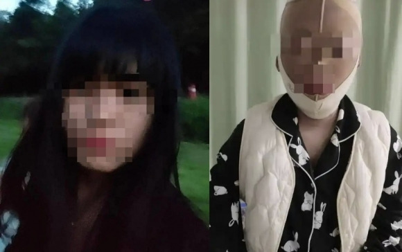 전 남자친구의 재결합 요구를 거절한 뒤 전 남자친구가 뿌린 휘발유에 전신 화상을 입은 중국 여성 천모(28)씨(오른쪽). 왼쪽은 사고 전 모습. 자료 : 양즈완바오