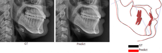 (왼쪽부터) AI가 예측한 수술 후 영상, 실제 수술 후 영상, 두 영상 간 차이를 보여주는 이미지(제공=서울아산병원)
