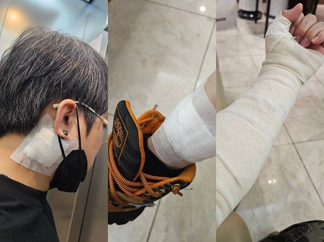 송백경이 문신 제거 수술 1회차를 진행했다. 인스타그램 캡처.