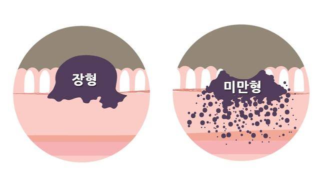 위암 형태에 따른 분류. 미만형 위암은 암세포가 점막을 따라 퍼지듯 분포돼 있어 조기 발견이 어렵고 예후도 좋지 않다. 분당서울대병원 제공