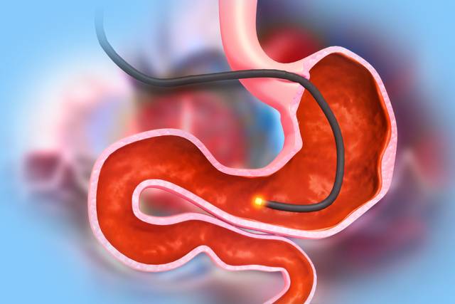 혈액검사 등을 통해 조기에 ‘미만형 위암’ 고위험군을 구분해 위암 발견의 효율성을 높일 수 있다는 연구결과가 나왔다. 사진은 기사의 특정 사실과 관련없음. 게티이미지뱅크