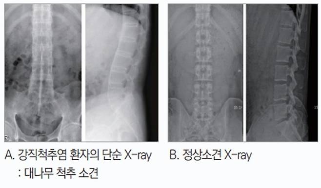 강직성척추염 환자의 단순 X-ray와 정상 X-ray. 분당제생병원 제공.