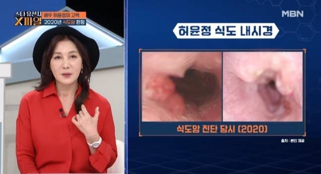 허윤정이 식도암 투병으로 고통스러웠던 시간을 고백했다. MBN ‘임성훈의 스타 유전자 X파일’ 방송 화면 캡처