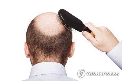 탈모. 사진 연합뉴스.