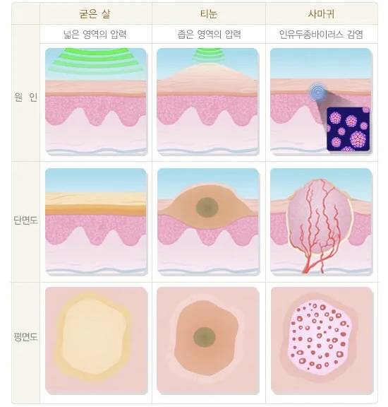 사마귀는 비슷해 보이는 굳은살이나 티눈과는 원인 및 병변 형태가 다르다. 보건복지부 제공