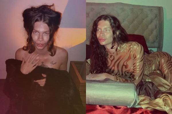 졸린 더슨(29)은 고양이처럼 보이고 싶어 필러 시술과 실리프팅 시술에 약 1000만 원을 지출했지만, 현재 후회해 필러를 제거하고 있다. 시술 후 모습./사진=더 선, 뉴욕 포스트