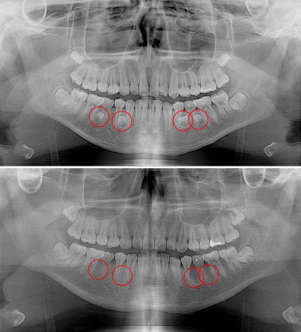 과잉치 수술 전(위)과 후./사진=고려대 안산병원 제공