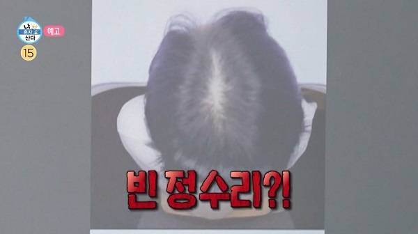 머리숱이 줄어든 박나래의 정수리 사진​/사진=MBC 예능 ‘나 혼자 산다’